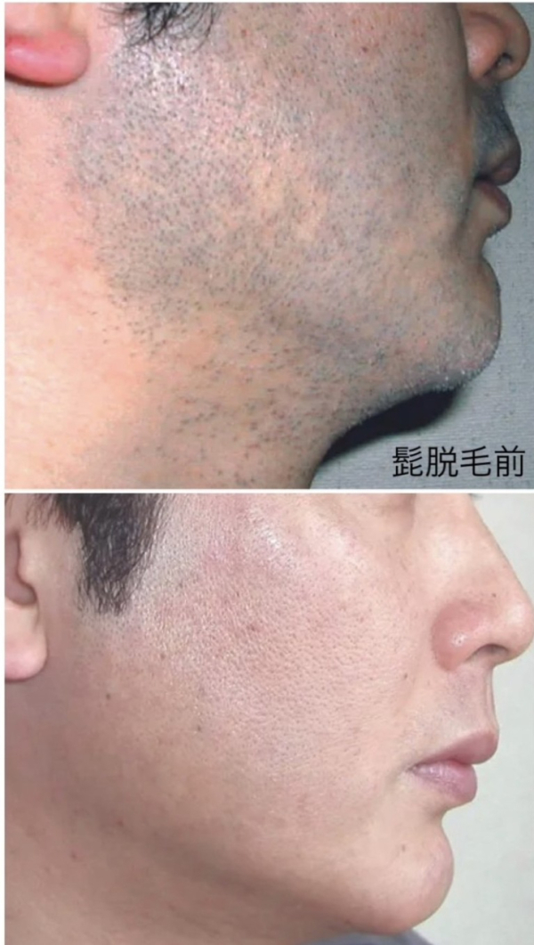 ヒゲ脱毛ビフォーアフター